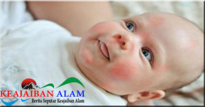 Penyebab Munculnya Alergi pada Anak Usia Dini